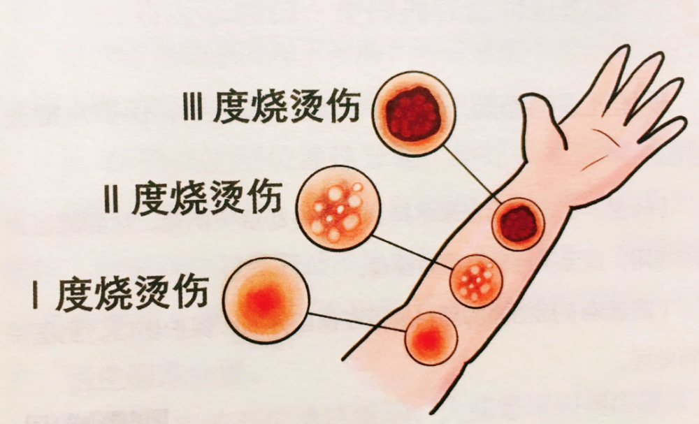 小面积烧伤的家庭急救指南